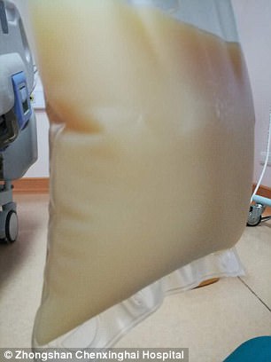 中山男子腹痛緊急送醫(yī)搶救，檢出“牛奶血”！