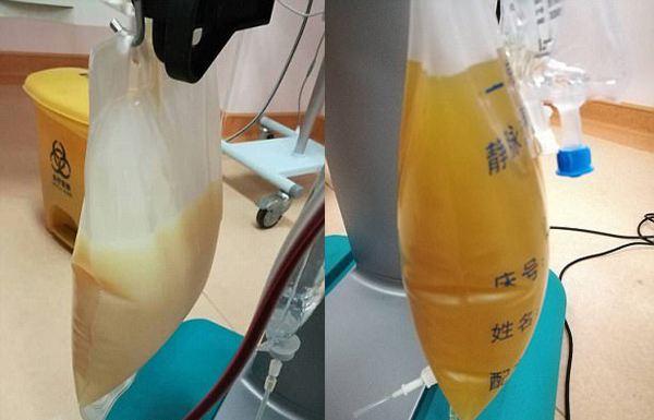 中山男子腹痛緊急送醫(yī)搶救，檢出“牛奶血”！