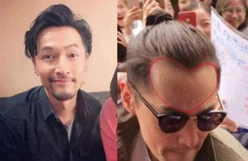 為什么男性禿頭都禿成一個(gè)樣？心疼男神們的發(fā)際線
